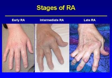 Rheumatoid Arthritis - Physiopedia