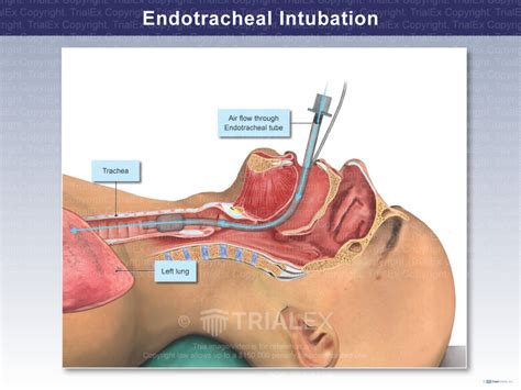 Endotracheal Intubation Anatomy