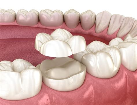 How Can a Dental Onlay Treat a Damaged Tooth? - Media Center Dental ...