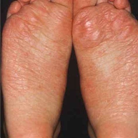 Proximal subungual onychomycosis due to Trichophyton rubrum in an ...