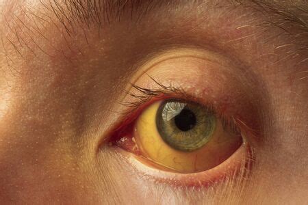 Photo of yellow staining of the sclera - ID:148010357 - Royalty Free Image - Stocklib