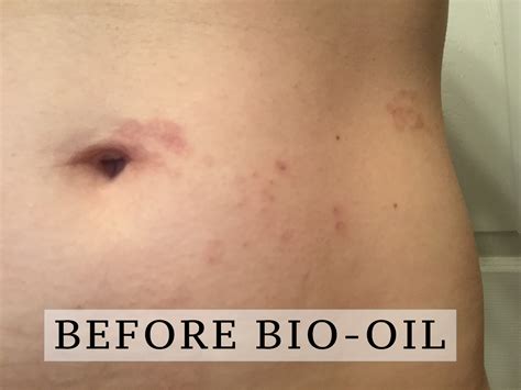 Bio Oil Before And After Pictures Scars - the meta pictures