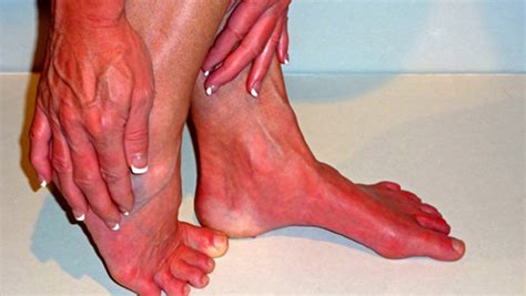 Burning Foot Pain Causes – Page 6 – Entirely Health