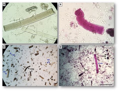 Urine Sediment of the Month: Waxy Casts - Renal Fellow Network