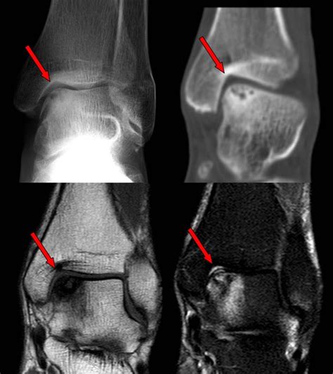 Ankle Cartilage Injuries London, UK | Arthroscopic (Key Hole) Microfracture Hertfordshire