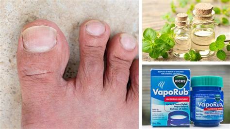 5 Natural Cures For Toenail Fungus You Can Find In Your Pantry