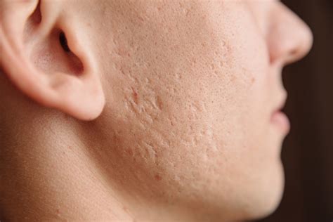 How to Manage Your Acne as an Adult - Alise Healing Center