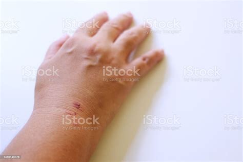 Dog Bite Wound Healing From A Dog Bite Stock Photo - Download Image Now ...