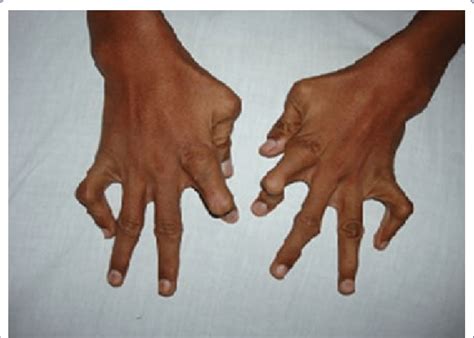 Hand Deformities At Birth