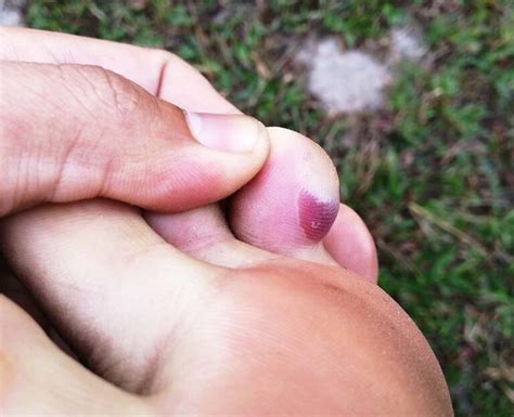 Say Goodbye to Painful Blood Blisters with This Ultimate Treatment Guide - UseVoucher Blog