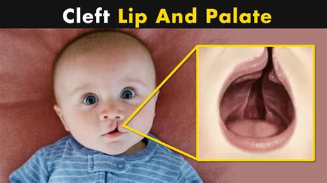 What Causes Cleft Lip And Cleft Palate? | Symptoms, Causes And Treatment - YouTube