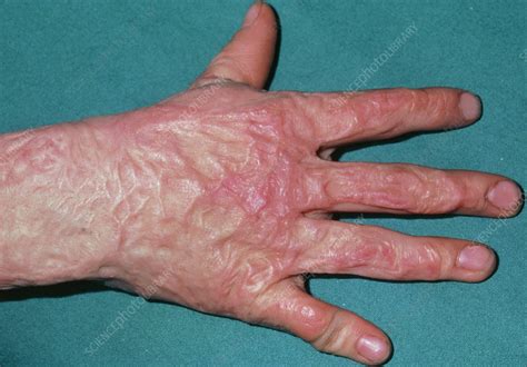 3rd Degree Burn Scar Hand