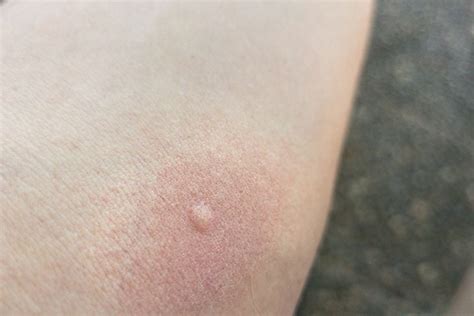 What Do Harmless Spider Bites Look Like