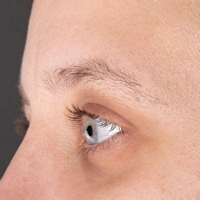 Eyebrow hair transplant for alopecia areata in Islamabad