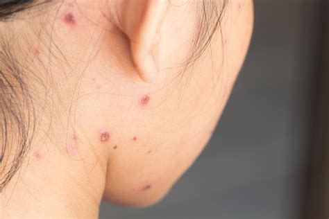 How to Remove Chicken Pox Scars from Skin? - Healthwire