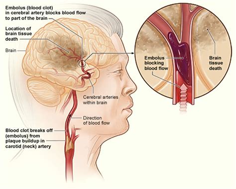 Substance in Humans is Effective Fighting Stroke Damage - Neuroscience News