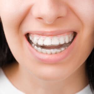 What is a Dental splint, and Why are they necessary?