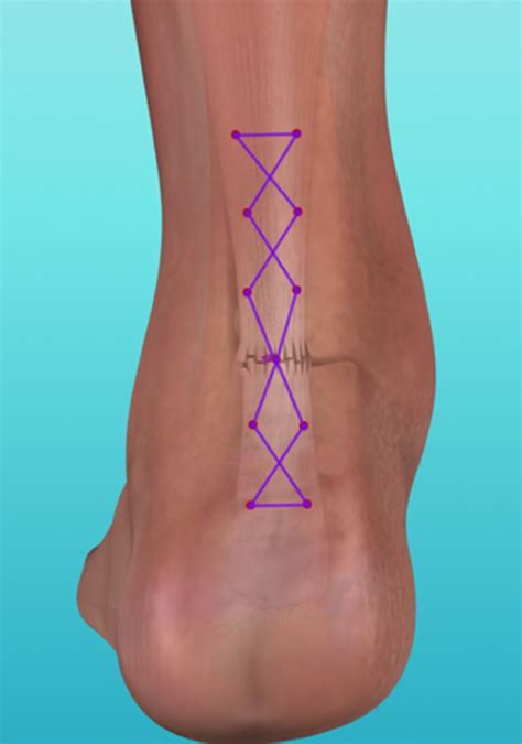 Percutaneous Repair Technique for Acute Achilles Tendon Rupture with ...