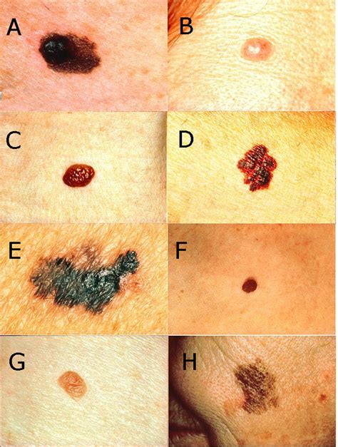 Melanoma Skin Cancer Spots On Face