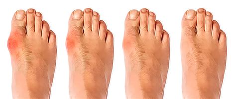 Bunion Surgery | Foot Doctor Southlake, Keller, Flower Mound, North ...