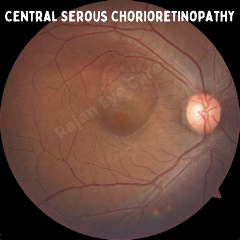 Central Serous Chorioretinopathy!