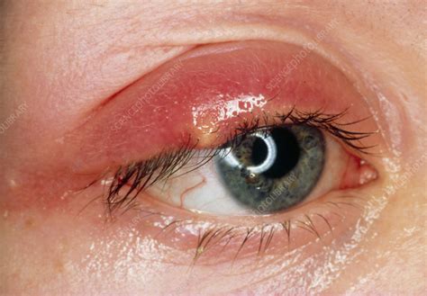 Stye on upper eyelid - Stock Image - M130/0093 - Science Photo Library