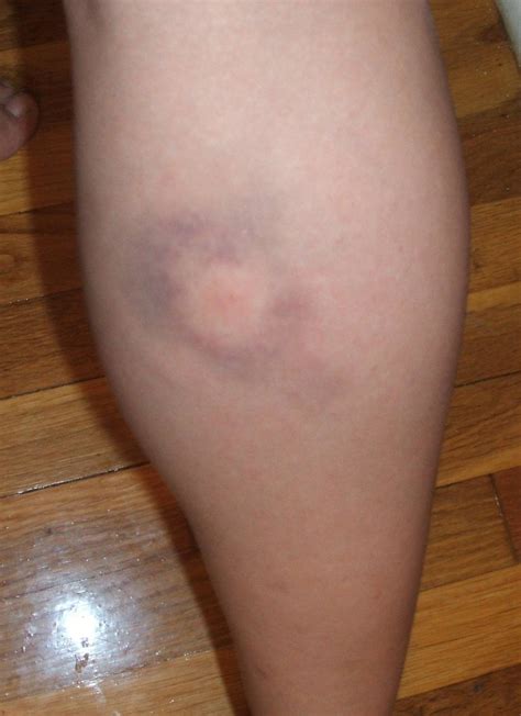 Bullseye bruise from spider bite (real) | Inj Sim MU Ref | Pinterest