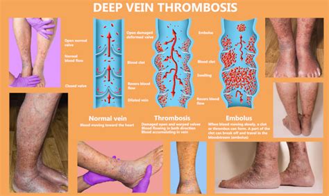 Should You Wear Ted Stockings If You Have A Dvt