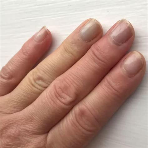 Cold, numb and painful fingers and toes – Raynaud’s Phenomenon – Care ...