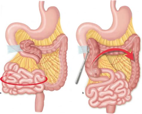 Cecal Vs Sigmoid Volvulus - Mari-Kiketi