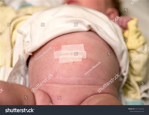 Umbilical Hernias Infant Treatment Tape Stock Photo 1571102725 ...