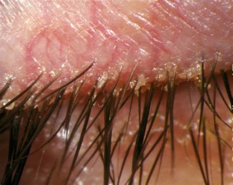 What Causes Blepharitis Swollen Eyelids