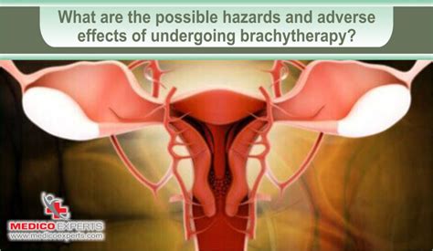 Effectiveness of Brachytherapy for Cervical Cancer