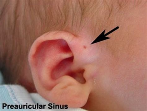 "Pre-auricular sinus is a small blind pit that occurs most commonly anterior to theroot of the ...