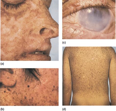 Mutations In Humans Caused By Radiation