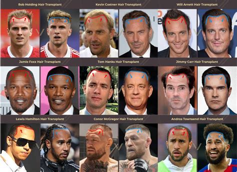 Top 48 image celebrities with hair transplants - Thptnganamst.edu.vn