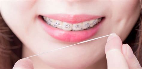 Flossing With Braces - What is the Best Way? [How to Guide]