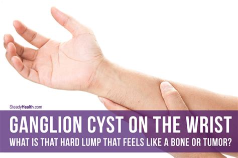 Ganglion Cyst On The Wrist: What Is That Hard Lump That Feels Like a Bone or Tumor ...