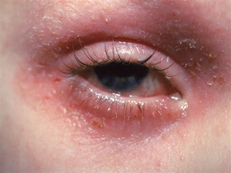Eyelid dermatitis causes, symptoms, diagnosis & treatment