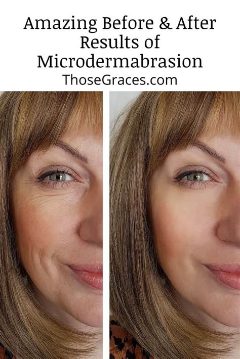 5 Amazing Before and After Results of Microdermabrasion - ThoseGraces.com