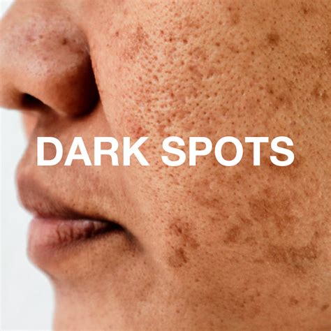 The Science Of Dark Spots | Causes & Remedies – Soulflower.in