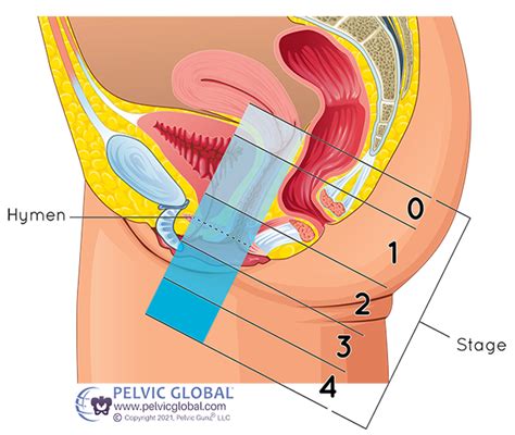 Anatomical vs. Symptomatic Prolapse | The Differences — enCORE Therapy