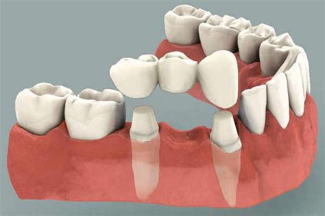 Fixed Partial Denture Bridge