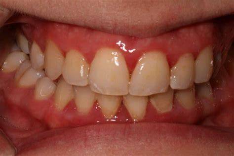 Gum Disease Pictures: What do Healthy Gums Look Like? - Crest