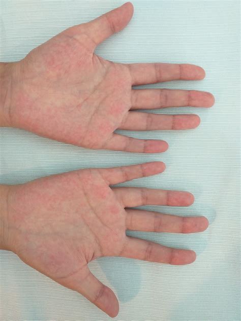 Albamv Palmar Erythema In Chronic Liver Disease - vrogue.co