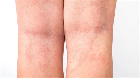 Acute Atopic Dermatitis On The Legs Behind The Knees Of A Child Is A Dermatological Disease Of ...