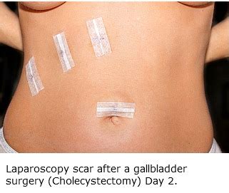 Laparoscopy Pictures