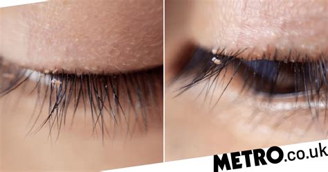Stomach-churning photos shows eyelashes infested with 'lash lice' as cases are on the rise ...