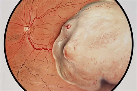 Choroidal melanoma treatment advances