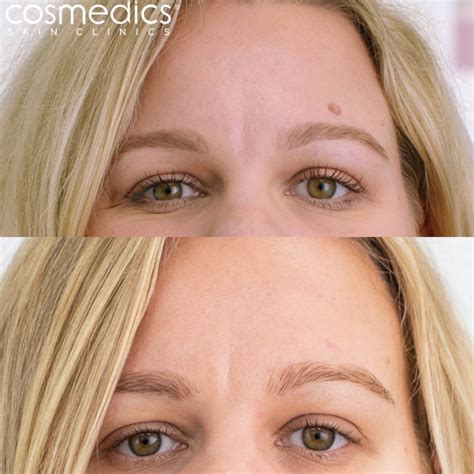 Laser Removal of Large Facial Mole | London Mole Removal